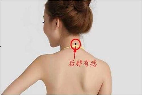 脖子有痣图片